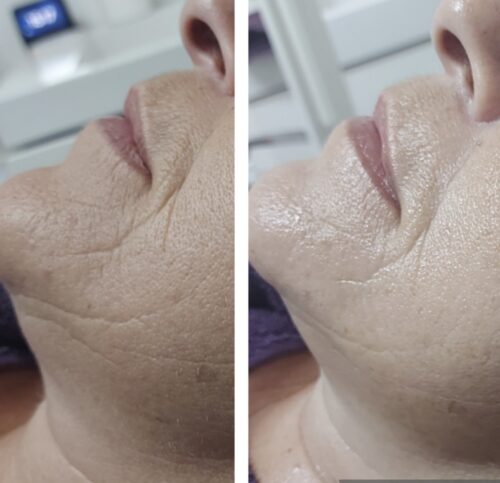 Hydrafacial voor en na